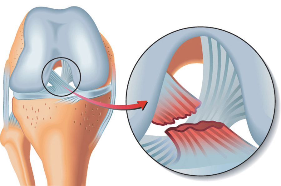 Knee Ligament Injury