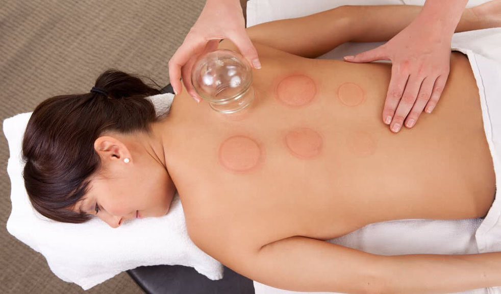 Cupping therapy and the various advantages it provides